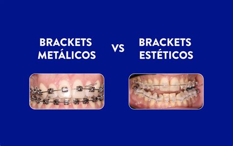 que es mejor los brackets esteticos o metalicos|bracket autoligado vs convencional.